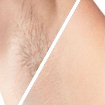 Professional IPL Laser Hair Remover – Long-Lasting Face & Body Hair Removal for Women & Men